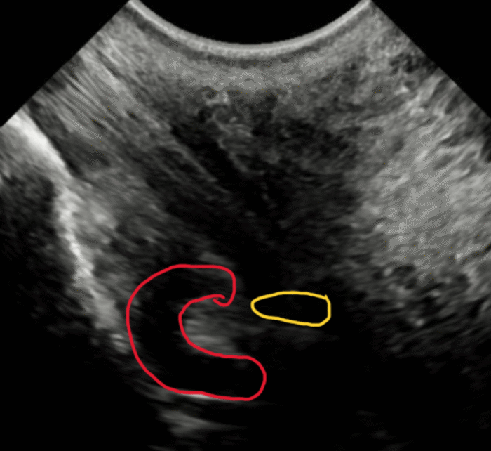Ultrasound of coffin joint navicular bursa – Barrett Equine Lameness – Ocala, FL and Colorado Springs, CO Ultrasound of coffin joint navicular bursa - Barrett Equine Lameness - Ocala, FL and Colorado Springs, CO