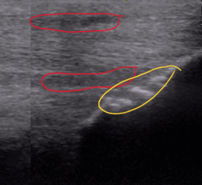 Ultrasound suspensory branch – Barrett Equine Lameness – Ocala, FL and Colorado Springs, CO Ultrasound suspensory branch - Barrett Equine Lameness - Ocala, FL and Colorado Springs, CO